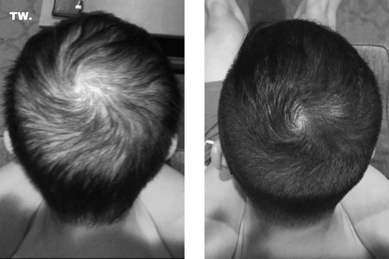 Understanding Hair Loss in Men: The Real Science Behind the Ritual
